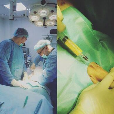 Penis thickening is possible with the help of surgery.